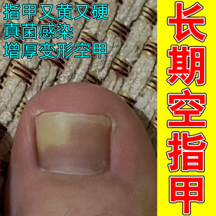 长期空指甲指甲又黄又硬真菌甲脱落坏甲甲分层坏甲甲凹凸不平修复