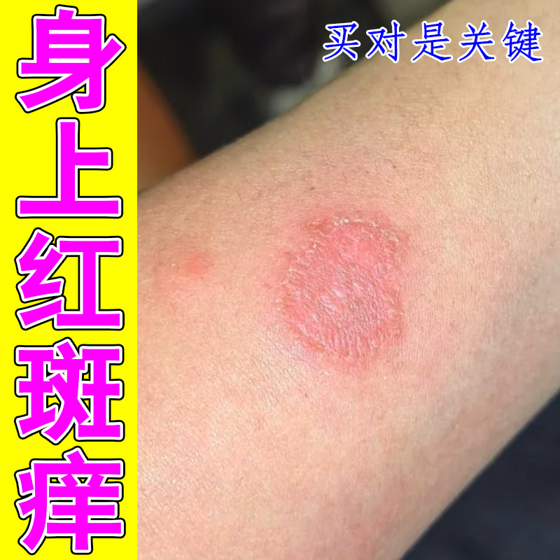 身上红斑痒掉屑粗糙圆斑掉屑鳞屑痒神经性皮肤干痒刺挠一抓一片红