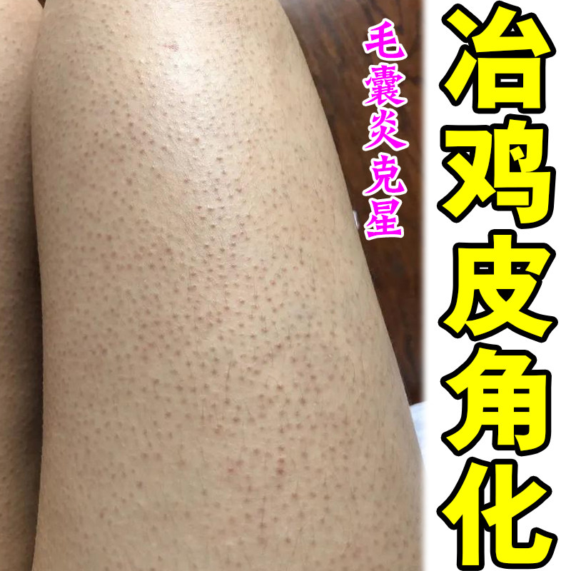皮肤毛周角化身上起黑点皮肤干燥难看粗糙毛囊堵塞专用软化保湿