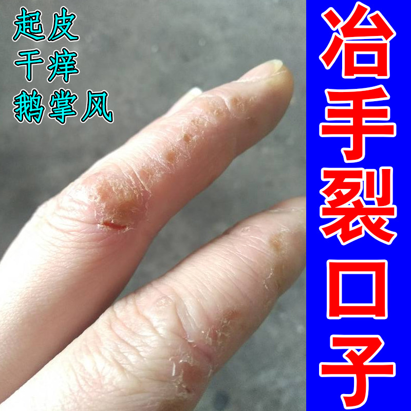 手裂口子手上起皮手干燥粗糙药乳