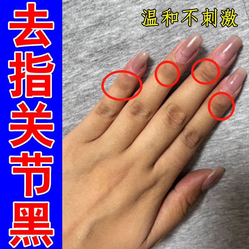 手指关节肤色偏深指根老角质堆积双手粗糙干黑色素沉淀专用修护药
