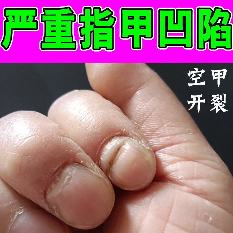 指甲盖凹凸发黄肉分离药