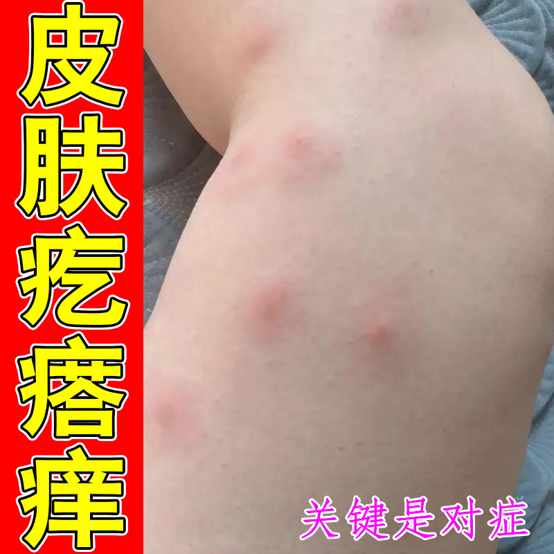 皮肤疙瘩痒腿上长小红痘过敏粗糙神经性感染蚊虫咬刺挠一抓一片红
