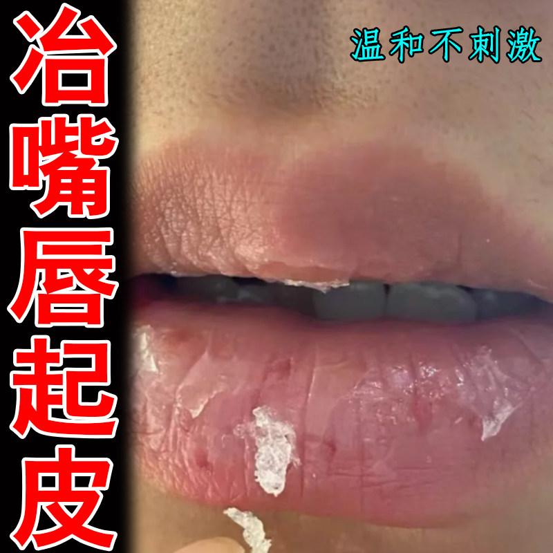 冶嘴唇起皮干裂脱皮掉屑红肿羊山胡皮肤干粗糙蜕皮剥脱性角质松懈