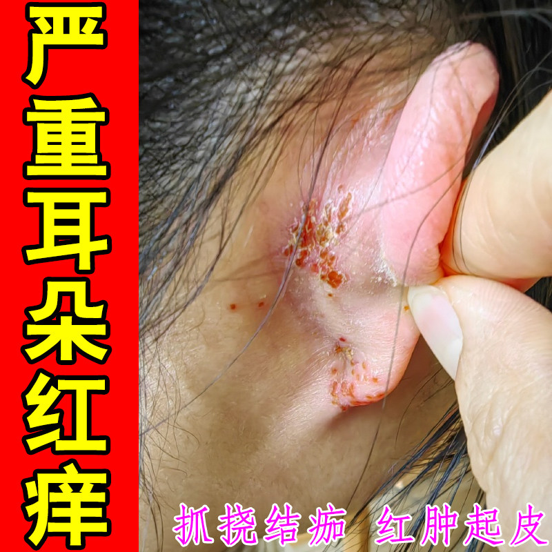 严重耳朵红痒起皮掉屑外耳朵皮屑粗糙干燥痒外耳道湿痒红肿过敏痒