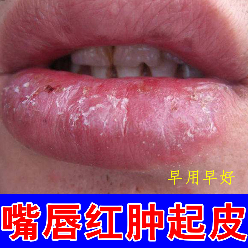 嘴唇红肿起皮专用嘴角起水泡裂口子脱皮松懈症干燥刺痛修护药乳膏