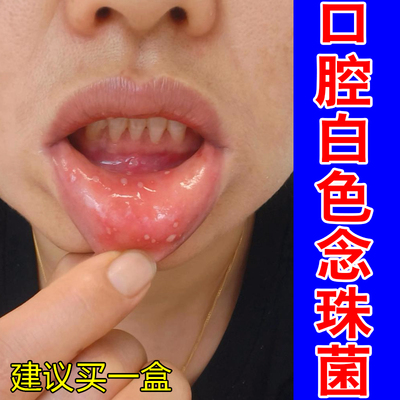 口腔白色念珠口腔菌唇舌黏膜白斑糜烂烧灼感口干扁平溃烂草本喷剂