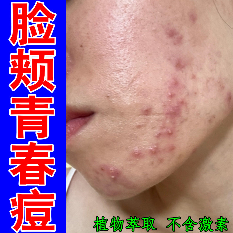 脸颊青春痘额头痘内分泌失调上火熬夜痘脸上长痘小颗粒外用草本药