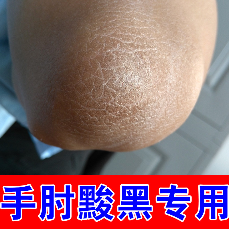 手肘黢黑专用皮肤干燥掉屑胳膊肘黑去死皮脖子后面黑腋下膝关节黑