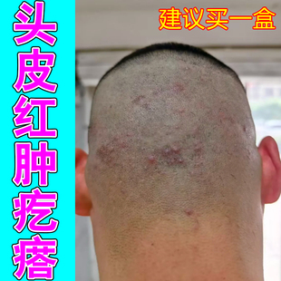 头皮红肿疙瘩脂溢红肿粗糙痘头皮发痒有脓包干燥修复药乳膏专用