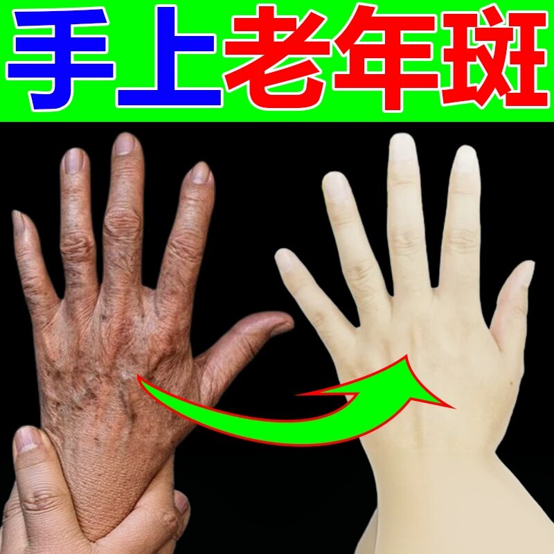 手上老年斑手部斑手背晒黑斑黑色素沉淀斑霜