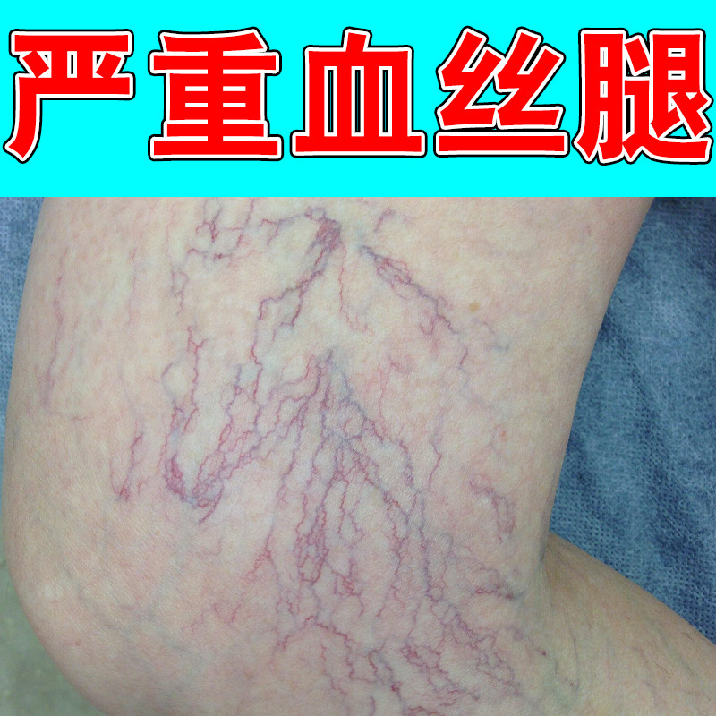 严重血丝腿肿胀久坐久站小腿毛细血管扩张青筋暴起难受肿胀草本药