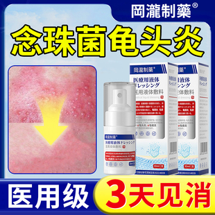 念珠菌性龟头炎男性私处专用真菌感染珍珠丘疹包皮白垢特效喷剂