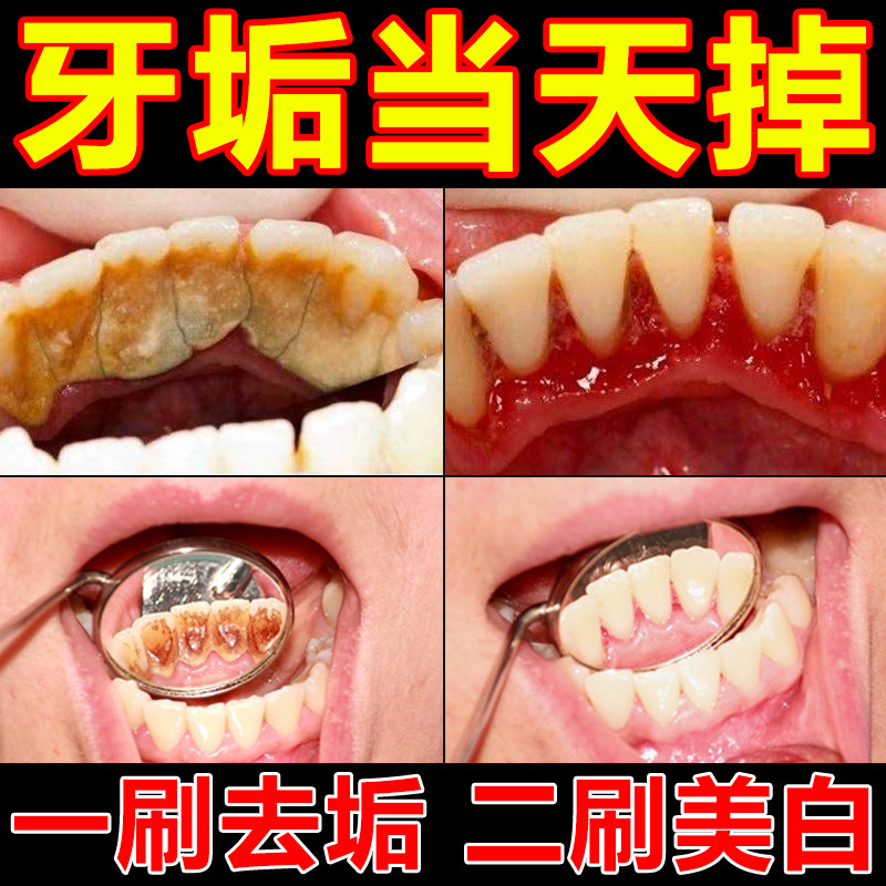 去牙渍牙垢黄牙速效去黄黑茶烟渍牙菌斑去黄去口臭牙结石清除神器