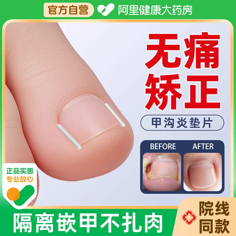 甲沟矫正器贴片炎嵌甲神器防脚指甲往肉里长专用隔离工具填充垫片