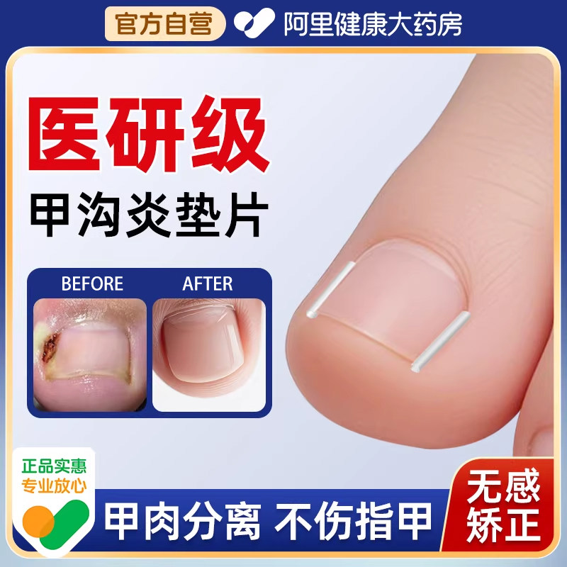 甲沟矫正器炎正甲贴指甲贴片嵌甲脚趾甲往肉里长纠正填充垫片