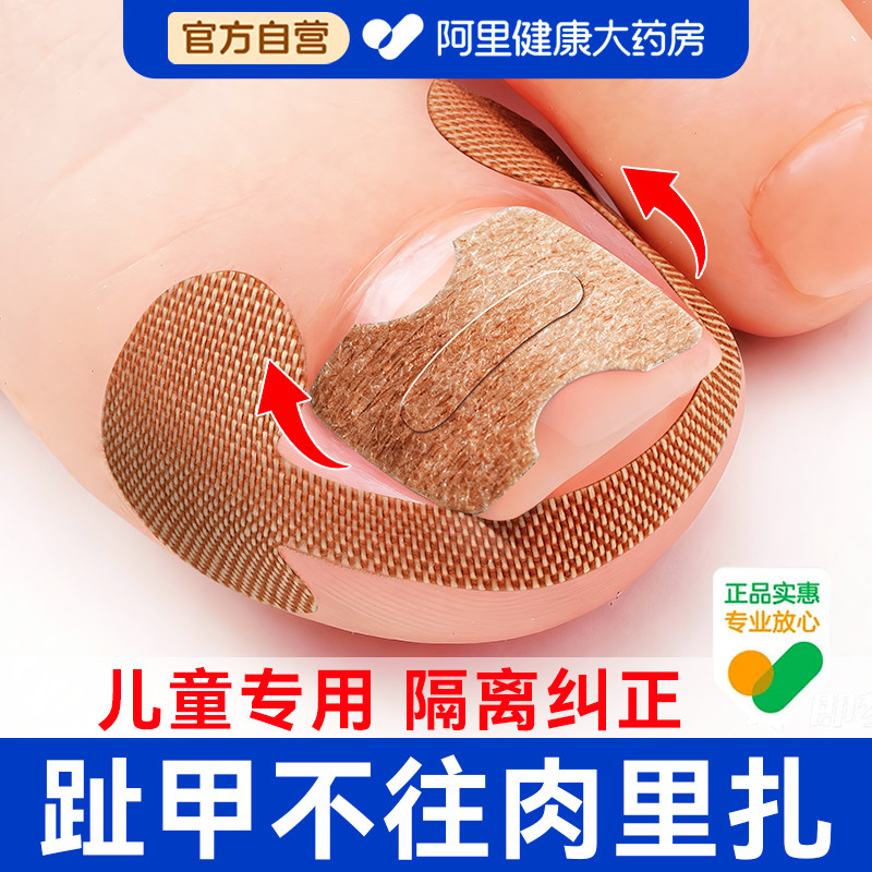 甲沟矫正器嵌甲往肉里长儿童专用隔离贴片正甲垫纠正神器脚趾甲炎