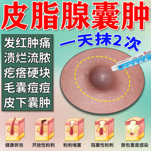 红霉素软膏正品消炎皮脂腺囊肿火疖子药膏脓包型红肿硬块痘痘流脓
