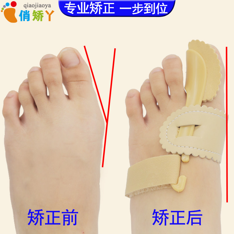 大脚骨突出矫正器夜用加强款姆指外翻纠正脚指拐弯曲乐姆款矫正器
