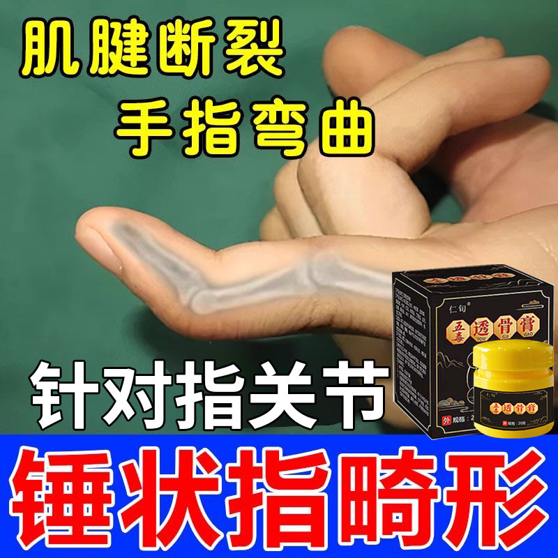 锤状指矫正器手指变形弯曲肿大修复膏肌腱断裂畸形伸不直关节僵硬