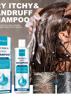 Psoriasis shampoo hair deep cleansing refreshing anti-dandru