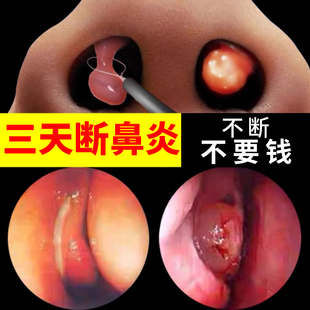 鼻炎喷雾剂专用儿童慢性鼻窦炎药软膏断根官方正品 自营