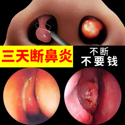 【自营】鼻炎喷雾剂专用儿童慢性鼻窦炎药软膏断根官方正品