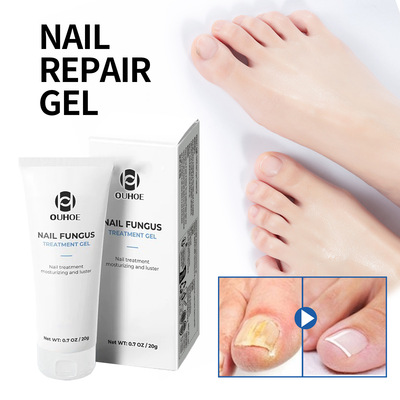 OUHOE指甲护理凝胶手足灰指甲