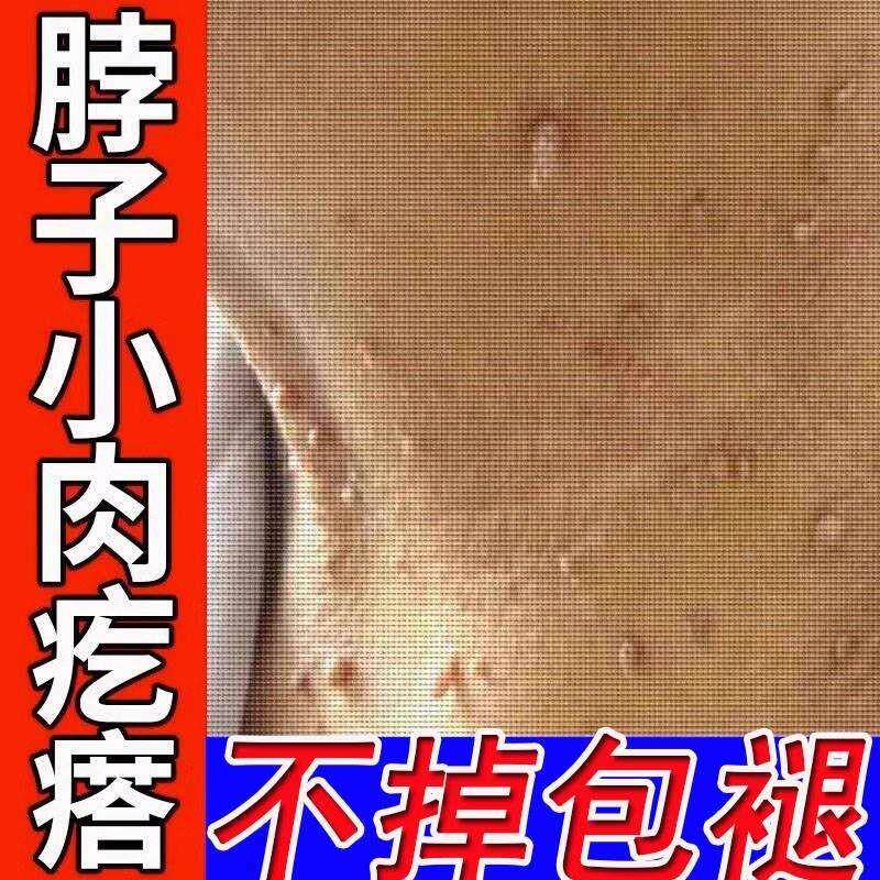 【一次消优】草本克尤膏去除脖子丝状忧寻常忧肉粒刺猴子膏祛除膏