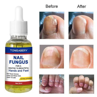 极速Nail Fungal Treatment Feet Care Essence Against XFungal