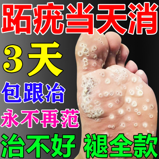 跖专用药膏疣去鸡眼肉刺足部脚底瘊子肉粒疙瘩祛根去除一抹无忧