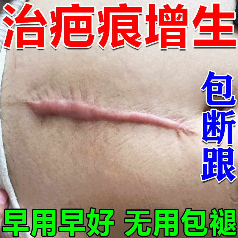 疤痕灵疙瘩胸前增生凹凸起软化修复膏去除去伤疤痕贴耳洞刀疤药膏
