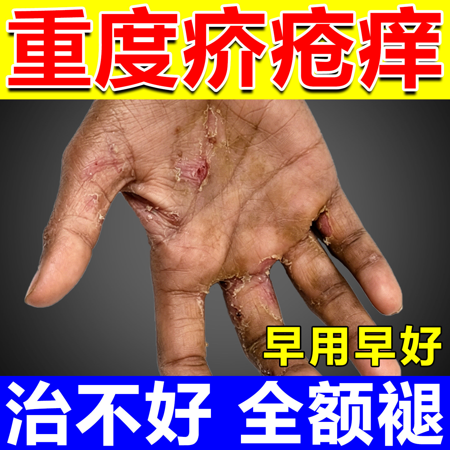疥疮药特效治疗疥疮结节皮肤瘙痒止痒疥螨虫专用硫磺软膏消毒软膏