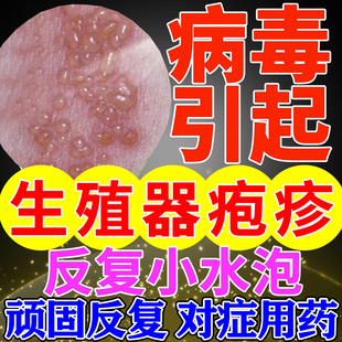 阿昔洛韦乳膏生殖器汗疱疹药膏带状疱疹男女私处病毒感染下体痒药