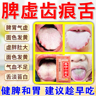香砂六君丸正品舌头舌苔白厚裂纹有齿痕健脾调理脾胃虚弱中成药