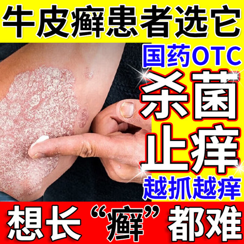 牛皮癣专用药膏抑菌止痒真菌感染