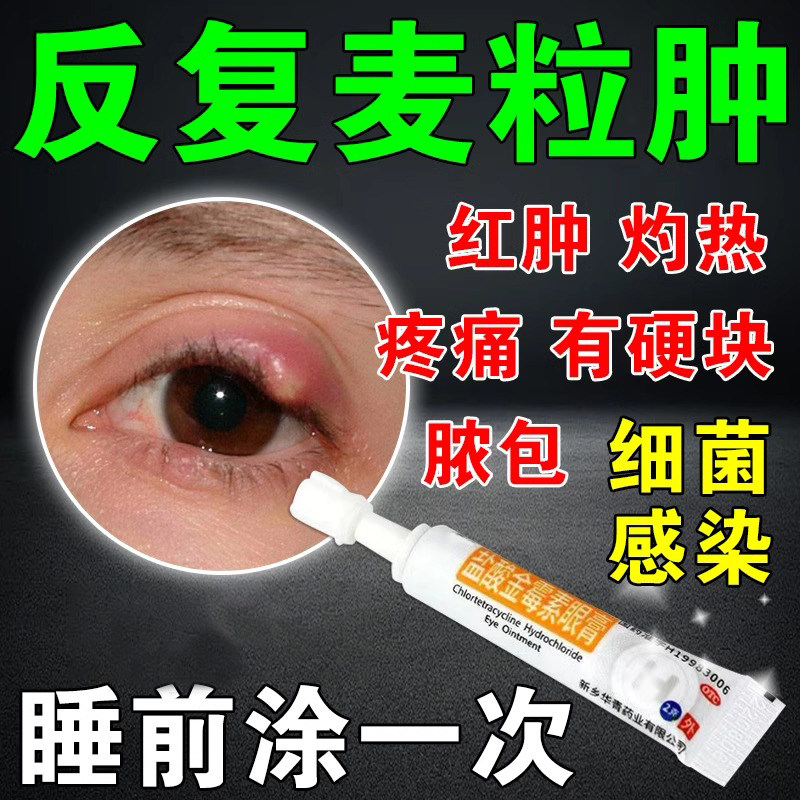 麦粒肿眼药膏霰粒肿针眼红肿眼皮红肿痒细菌感染盐酸金霉