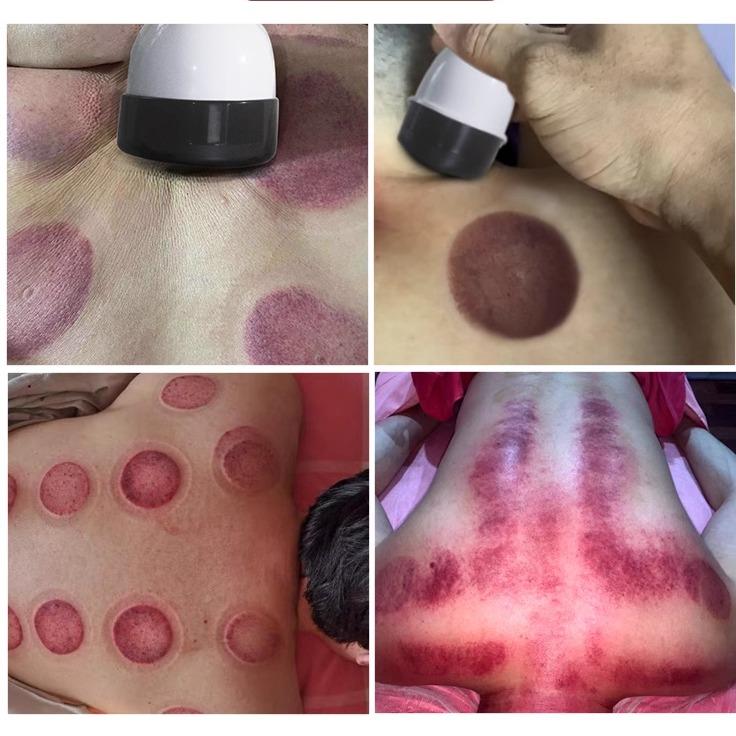 仪器电20135动痧容院美淋巴功拔罐刮通能痧多吸吸力肩颈家加疏机