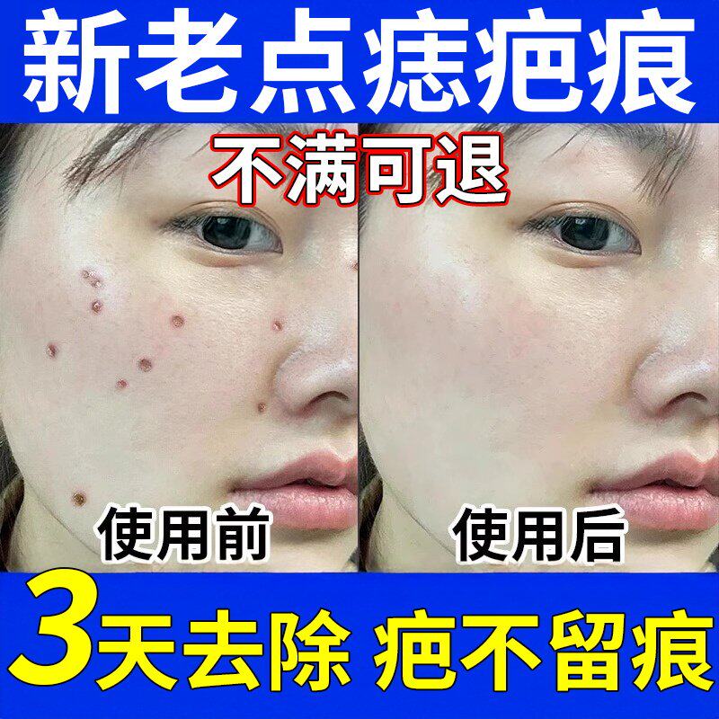 点痣膏点痣药水不留疤美容院专用面部健康