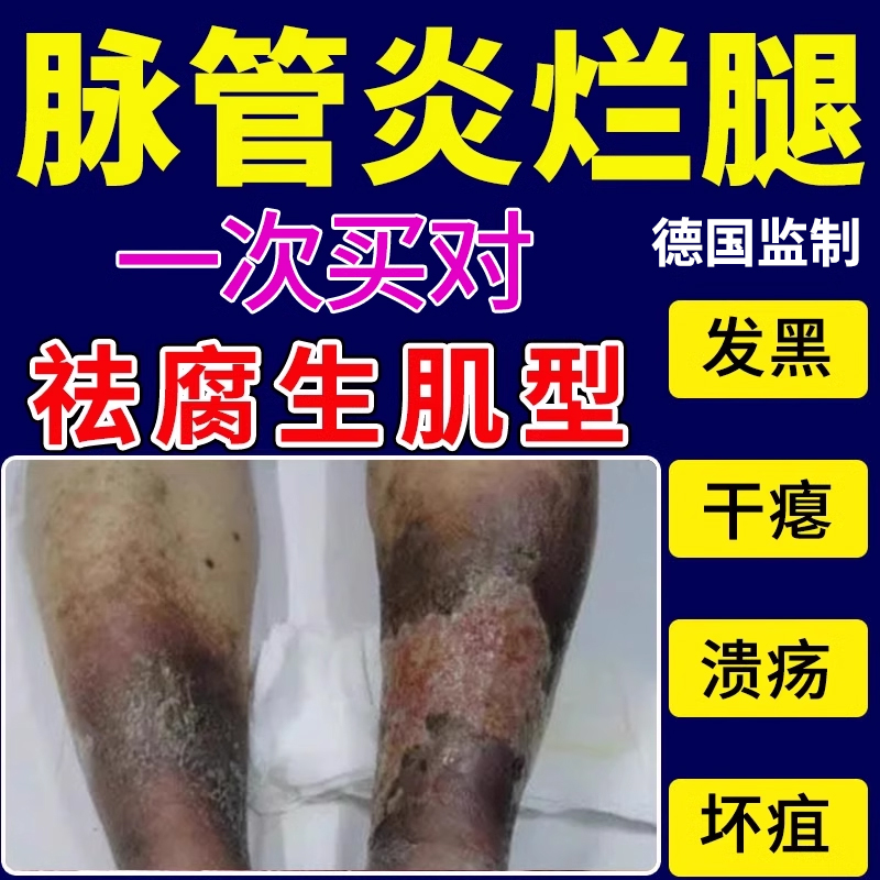 脉管炎老烂腿伤口愈合去腐生肌膏