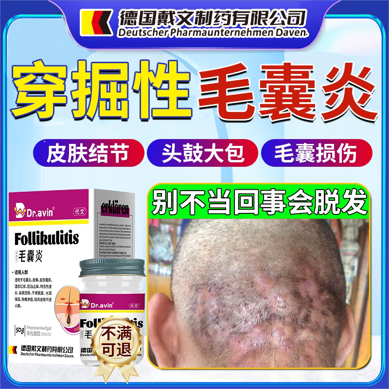 穿掘性毛囊炎头皮鼓大包疼痛红肿结节专用膏药房同售lt