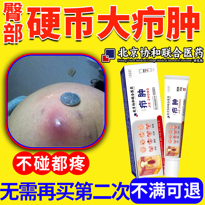 屁股周围长火疖子疖肿拔毒膏皮脂腺囊肿拔脓粉瘤去除坐板疮膏kj