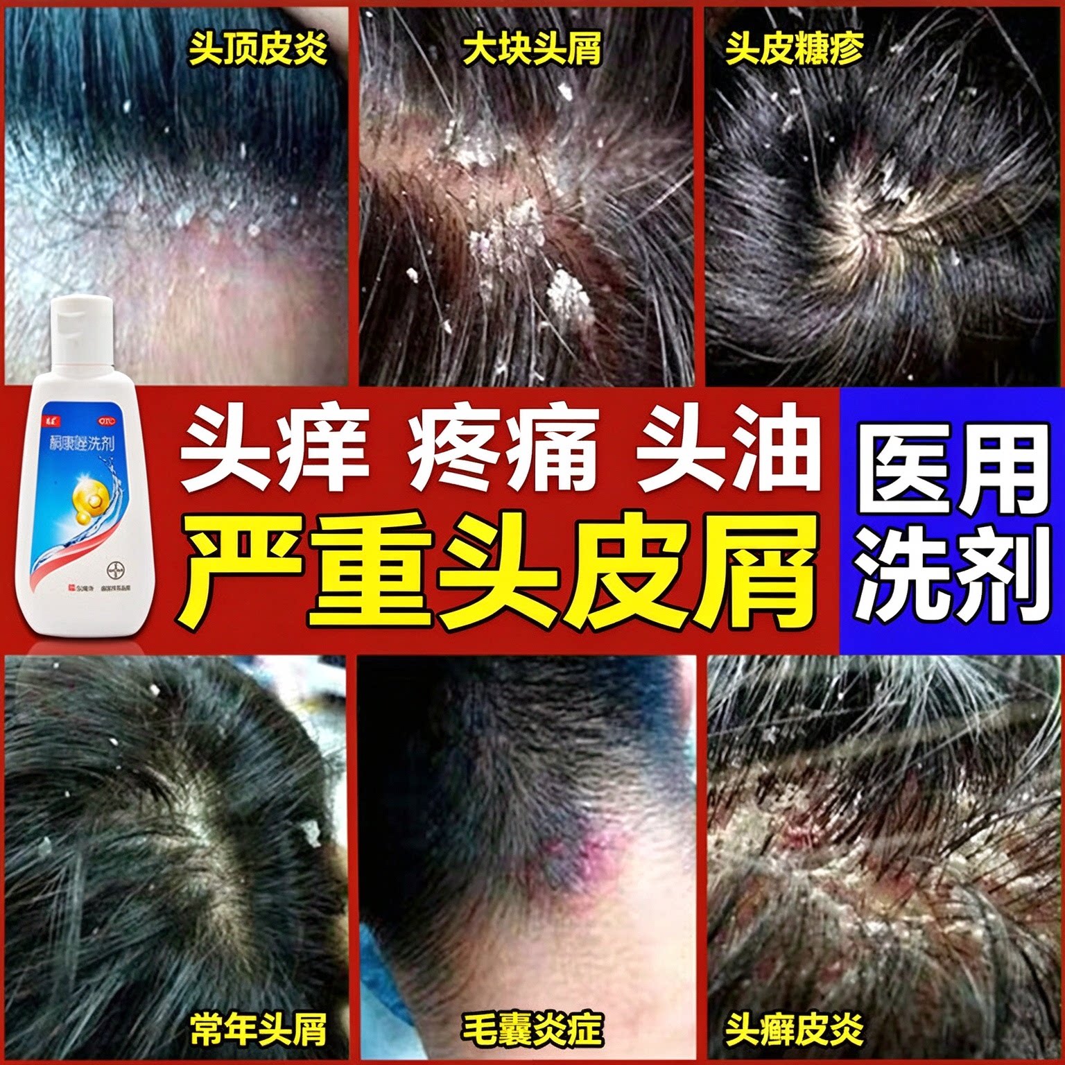 康王酮康唑洗剂头皮屑严重去头屑专用药脂溢性皮炎毛囊止痒去屑
