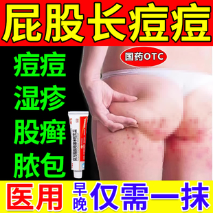 屁股上长痘痘痒起热毒疙瘩坐板疮屁股毛囊炎湿疹股癣真菌感染药膏