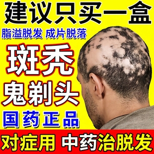 斑秃丸的特新效期药特鬼剃头治疗脱发严重男女专用口服药斑秃脱发