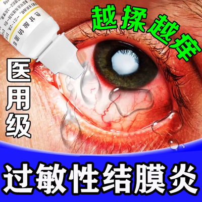 结膜炎眼药水止痒消炎杀菌眼睛有红血丝干涩流泪痒色甘酸钠滴眼液