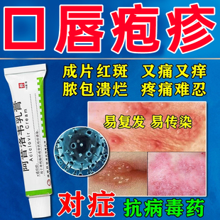 嘴唇口唇嘴巴上火起泡烂嘴角疱疹炎症疼痛药膏单纯性疱疹抗病毒药