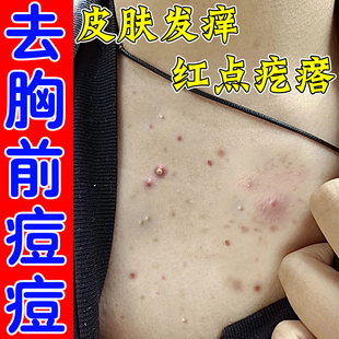 前胸后背痘专用膏胸口背上起红疙瘩长痘脂溢性去脓包痘神器