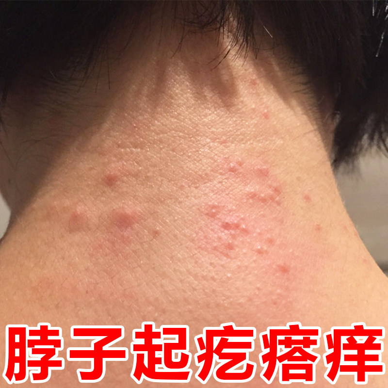脖子上痒颈部后面红肿神经性皮肤焱起红疙瘩用的乳膏