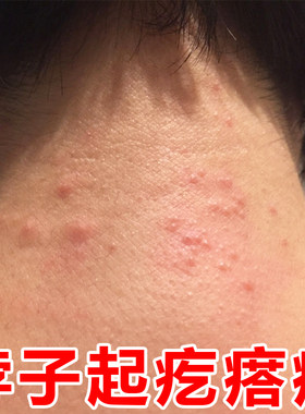 脖子上痒颈部后面红肿神经性皮肤焱起红疙瘩用的乳膏